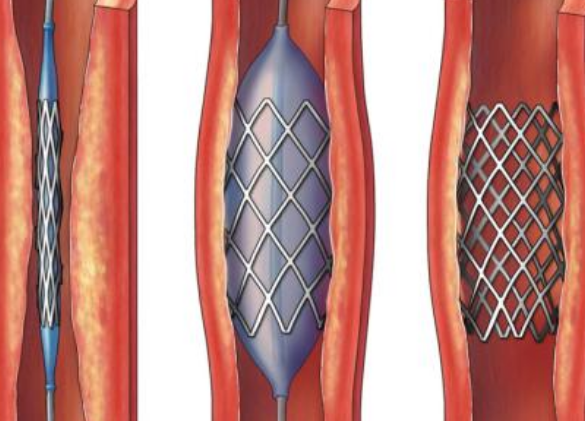 好消息！700元冠脈支架來(lái)了帶量采購(gòu)結(jié)果在甘肅省正式落地執(zhí)行